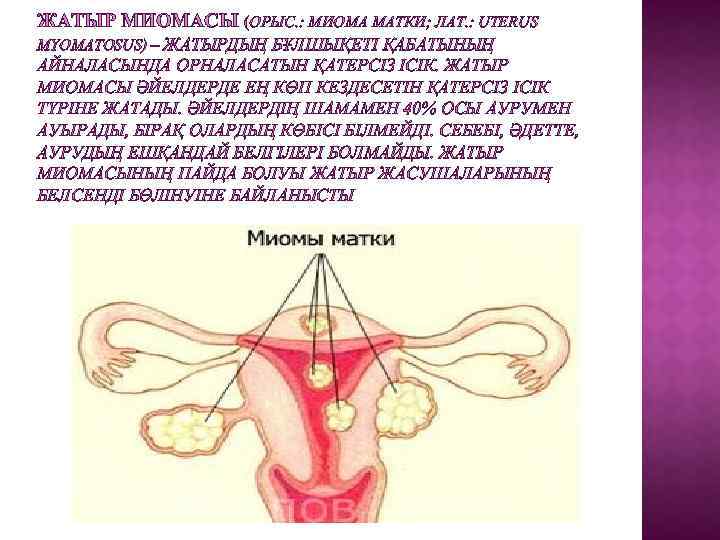 ЖАТЫР МИОМАСЫ (ОРЫС. : МИОМА МАТКИ; ЛАТ. : UTERUS MYOMATOSUS) – ЖАТЫРДЫҢ БҰЛШЫҚЕТІ ҚАБАТЫНЫҢ