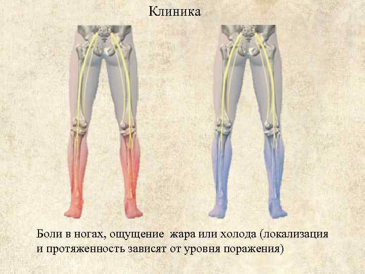 Клиника Боли в ногах, ощущение жара или холода (локализация и протяженность зависят от уровня