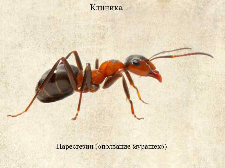 Клиника Парестезии ( «ползание мурашек» ) 