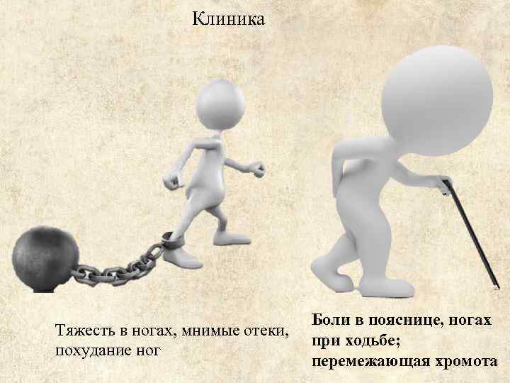 Клиника Тяжесть в ногах, мнимые отеки, похудание ног Боли в пояснице, ногах при ходьбе;