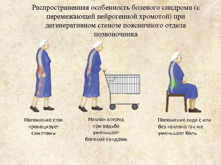 Распространенная особенность болевого синдрома (c перемежающей нейрогенной хромотой) при дегенеративном стенозе поясничного отдела позвоночника