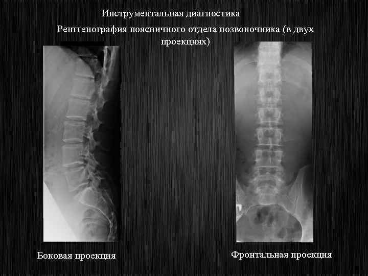 Инструментальная диагностика Рентгенография поясничного отдела позвоночника (в двух проекциях) Боковая проекция Фронтальная проекция 