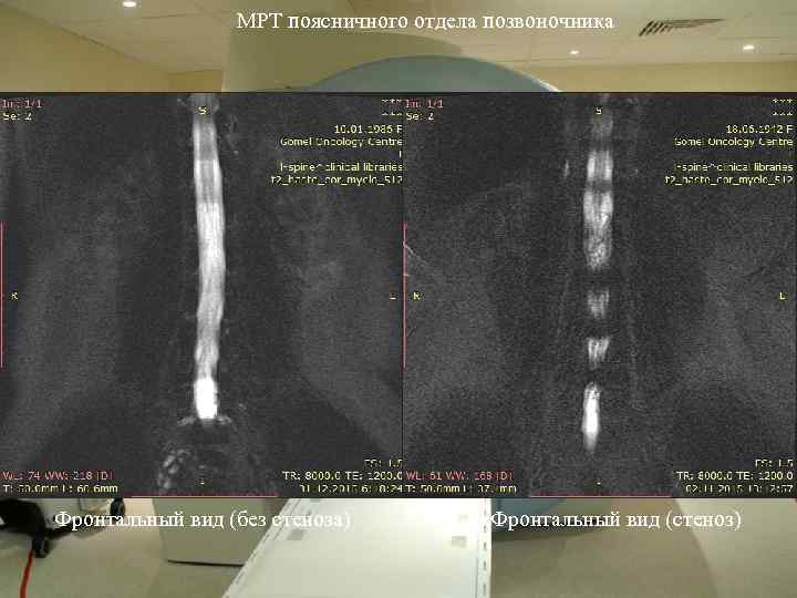 МРТ поясничного отдела позвоночника Фронтальный вид (без стеноза) Фронтальный вид (стеноз) 