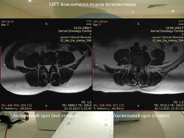 МРТ поясничного отдела позвоночника Аксиальный срез (нет стеноза) Аксиальный срез (стеноз) 