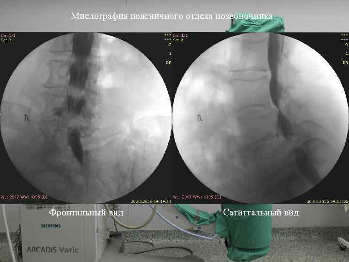 Миелография поясничного отдела позвоночника Фронтальный вид Сагиттальный вид 