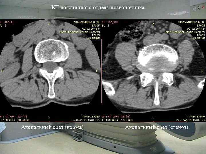 КТ поясничного отдела позвоночника Аксиальный срез (норма) Аксиальный срез (стеноз) 