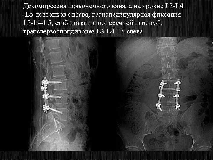 Декомпрессия позвоночного канала на уровне L 3 -L 4 -L 5 позвонков справа, транспедикулярная