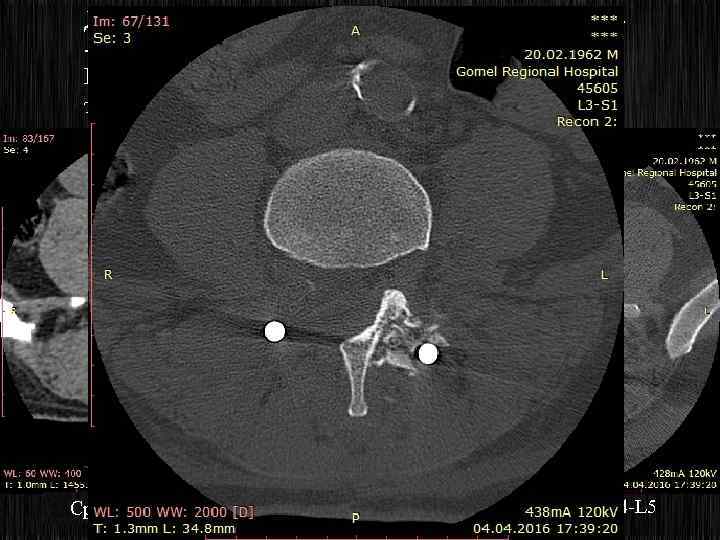 Декомпрессия позвоночного канала на уровне L 3 -L 4 -L 5 позвонков справа, транспедикулярная