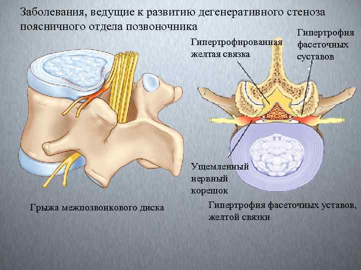 Заболевания, ведущие к развитию дегенеративного стеноза поясничного отдела позвоночника Гипертрофия Гипертрофированная желтая связка Грыжа