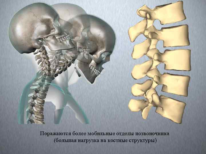 Поражаются более мобильные отделы позвоночника (большая нагрузка на костные структуры) 