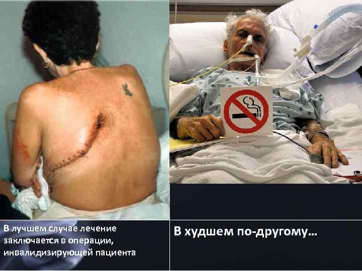 В лучшем случае лечение заключается в операции, инвалидизирующей пациента В худшем по-другому… 