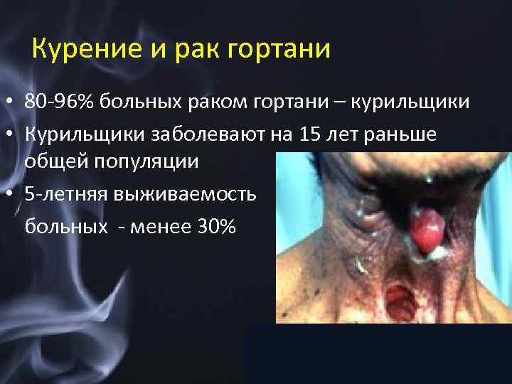 Курение и рак гортани • 80 -96% больных раком гортани – курильщики • Курильщики