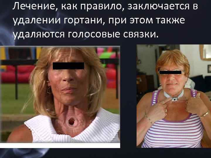 Лечение, как правило, заключается в удалении гортани, при этом также удаляются голосовые связки. 