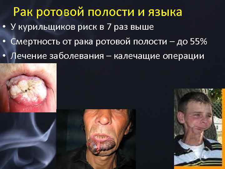 Рак ротовой полости и языка • У курильщиков риск в 7 раз выше •
