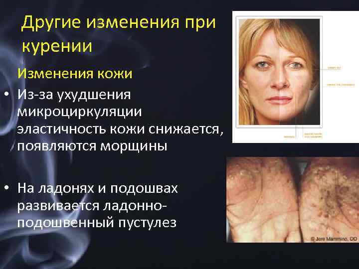 Другие изменения при курении Изменения кожи • Из-за ухудшения микроциркуляции эластичность кожи снижается, появляются