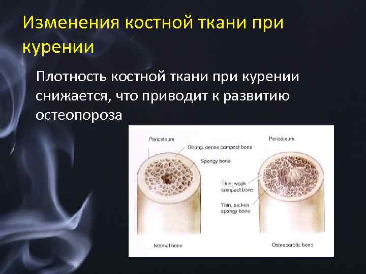 Изменения костной ткани при курении Плотность костной ткани при курении снижается, что приводит к