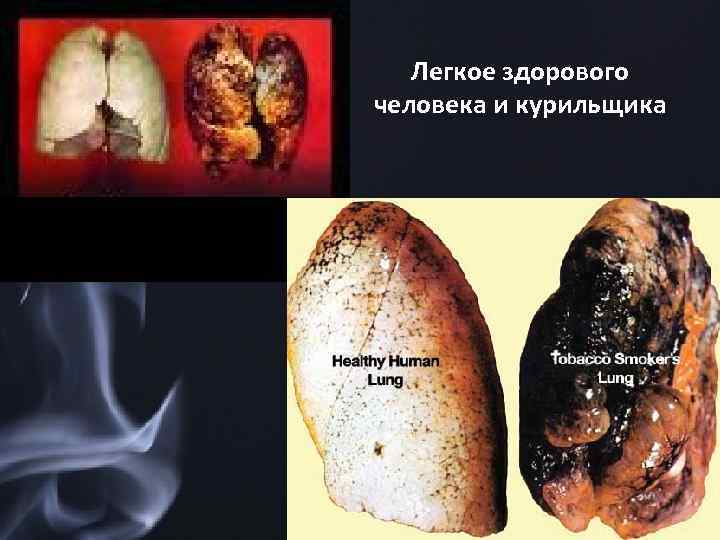 Легкое здорового человека и курильщика 