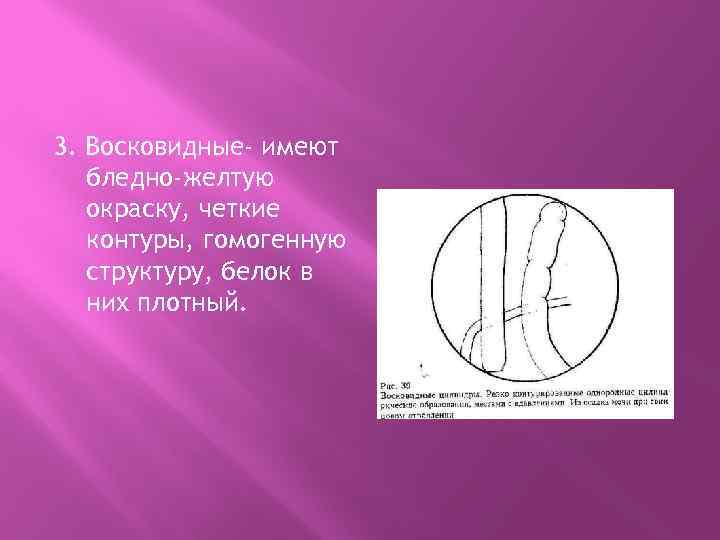 3. Восковидные- имеют бледно-желтую окраску, четкие контуры, гомогенную структуру, белок в них плотный. 