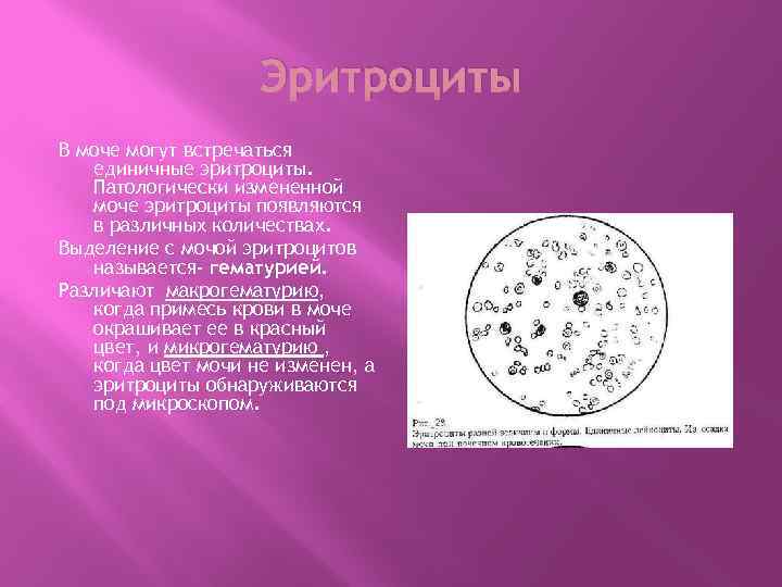 Эритроциты В моче могут встречаться единичные эритроциты. Патологически измененной моче эритроциты появляются в различных