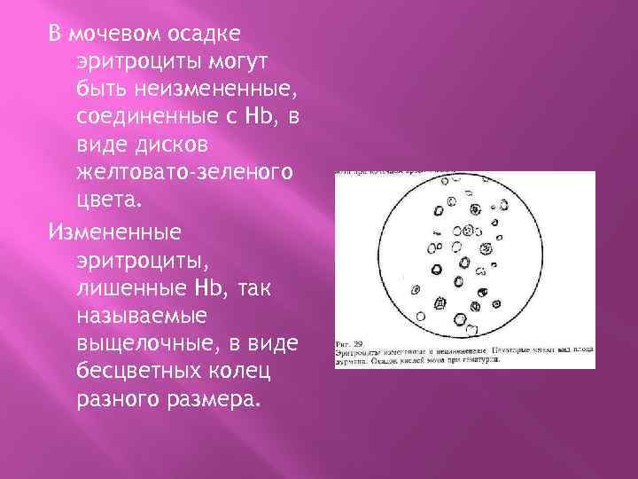 В мочевом осадке эритроциты могут быть неизмененные, соединенные с Hb, в виде дисков желтовато-зеленого