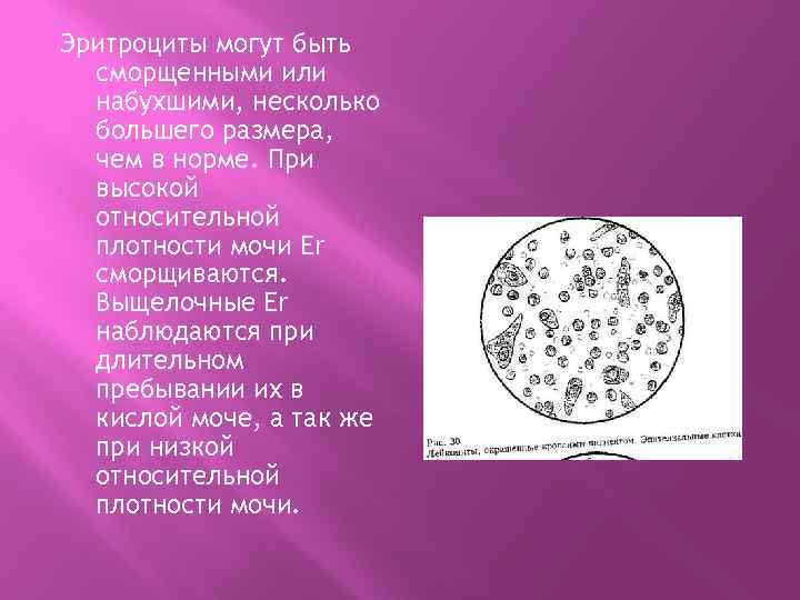 Эритроциты могут быть сморщенными или набухшими, несколько большего размера, чем в норме. При высокой