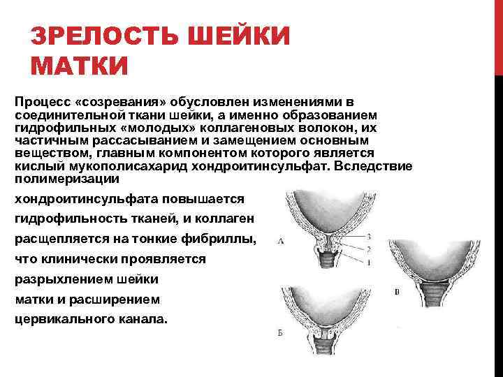 ЗРЕЛОСТЬ ШЕЙКИ МАТКИ Процесс «созревания» обусловлен изменениями в соединительной ткани шейки, а именно образованием