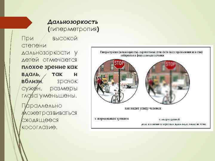 Дальнозоркость (гиперметропия) При высокой степени дальнозоркости у детей отмечается плохое зрение как вдаль, так