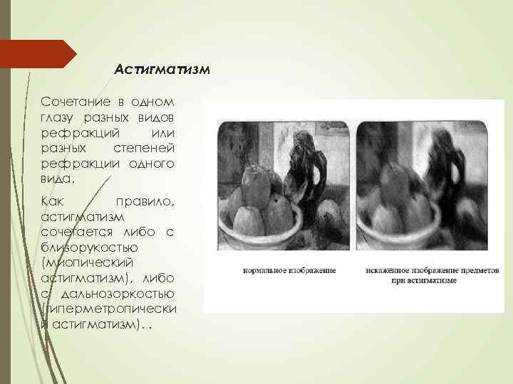 Астигматизм Сочетание в одном глазу разных видов рефракций или разных степеней рефракции одного вида.