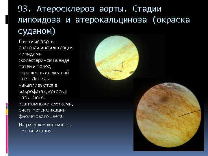 93. Атеросклероз аорты. Стадии липоидоза и атерокальциноза (окраска суданом) В интиме аорты очаговая инфильтрация