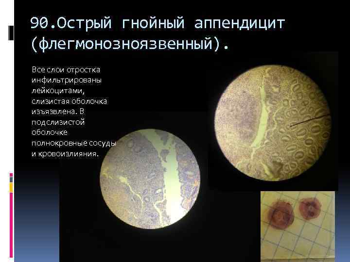 90. Острый гнойный аппендицит (флегмонозноязвенный). Все слои отростка инфильтрированы лейкоцитами, слизистая оболочка изъязвлена. В