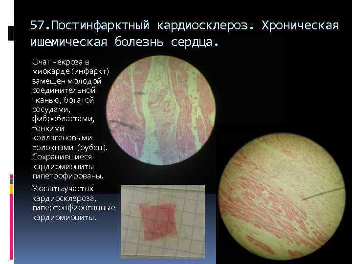 57. Постинфарктный кардиосклероз. Хроническая ишемическая болезнь сердца. Очаг некроза в миокарде (инфаркт) замещен молодой