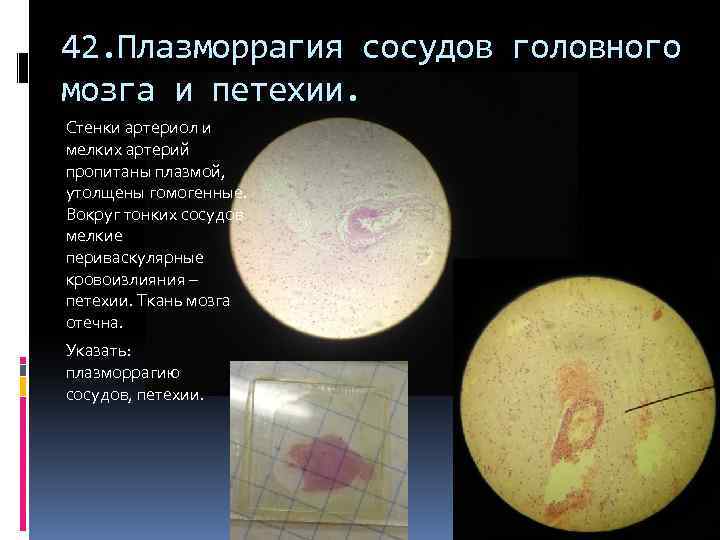 42. Плазморрагия сосудов головного мозга и петехии. Стенки артериол и мелких артерий пропитаны плазмой,