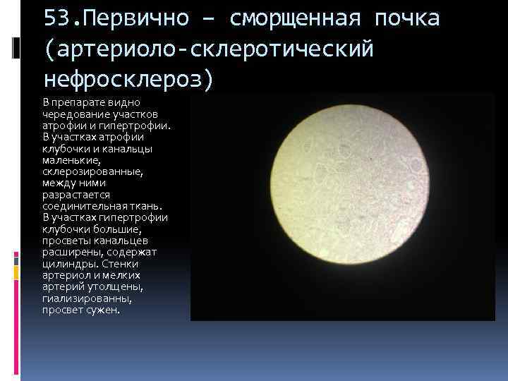 53. Первично – сморщенная почка (артериоло-склеротический нефросклероз) В препарате видно чередование участков атрофии и