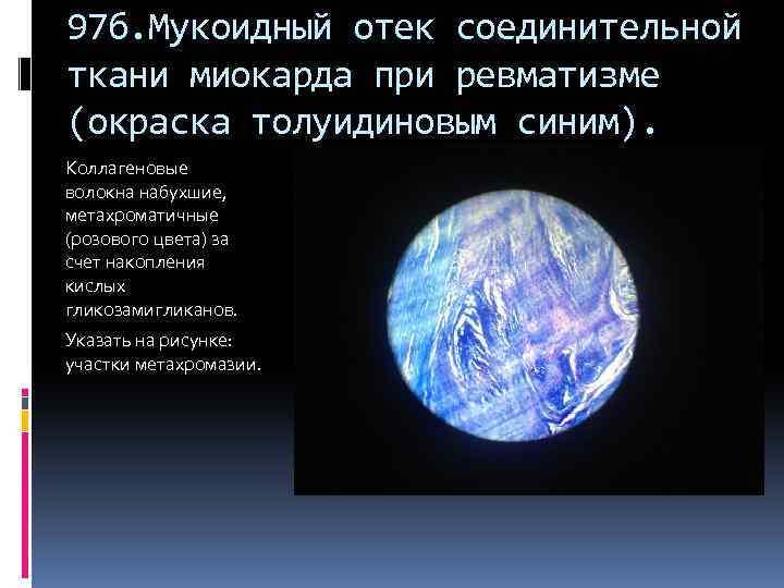 97 б. Мукоидный отек соединительной ткани миокарда при ревматизме (окраска толуидиновым синим). Коллагеновые волокна