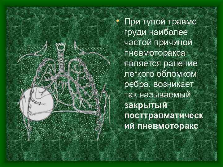  • При тупой травме груди наиболее частой причиной пневмоторакса является ранение легкого обломком