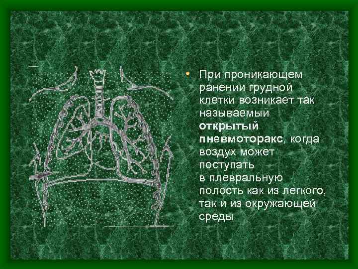  • При проникающем ранении грудной клетки возникает так называемый открытый пневмоторакс, когда воздух