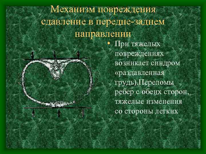 Механизм повреждения сдавление в передне заднем направлении • При тяжелых повреждениях возникает синдром «раздавленная