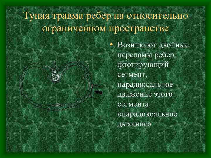 Тупая травма ребер на относительно ограниченном пространстве • Возникают двойные переломы ребер, флотирующий сегмент,