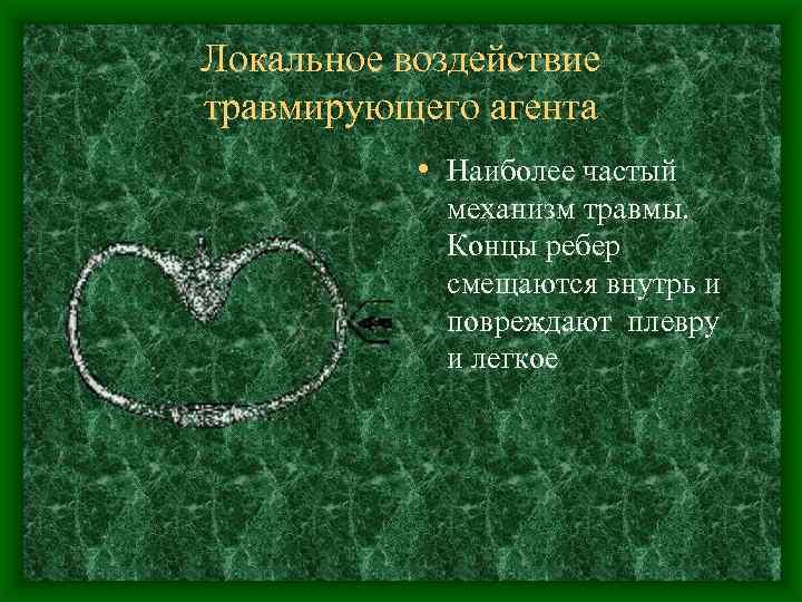 Локальное воздействие травмирующего агента • Наиболее частый механизм травмы. Концы ребер смещаются внутрь и