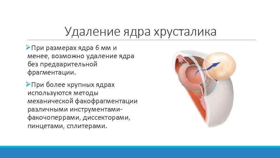 Удаление ядра хрусталика ØПри размерах ядра 6 мм и менее, возможно удаление ядра без