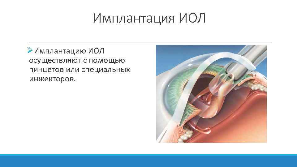 Имплантация ИОЛ ØИмплантацию ИОЛ осуществляют с помощью пинцетов или специальных инжекторов. 