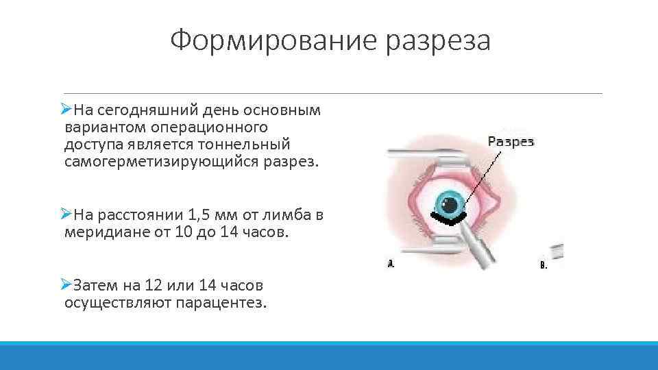 Формирование разреза ØНа сегодняшний день основным вариантом операционного доступа является тоннельный самогерметизирующийся разрез. ØНа