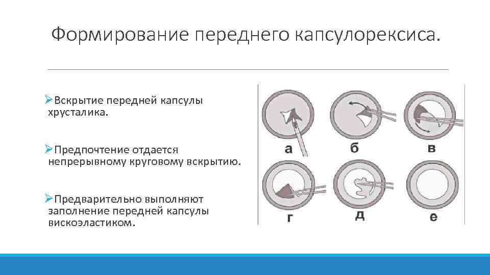 Формирование переднего капсулорексиса. ØВскрытие передней капсулы хрусталика. ØПредпочтение отдается непрерывному круговому вскрытию. ØПредварительно выполняют