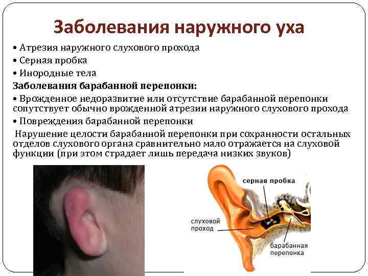 Заболевания наружного уха • Атрезия наружного слухового прохода • Серная пробка • Инородные тела