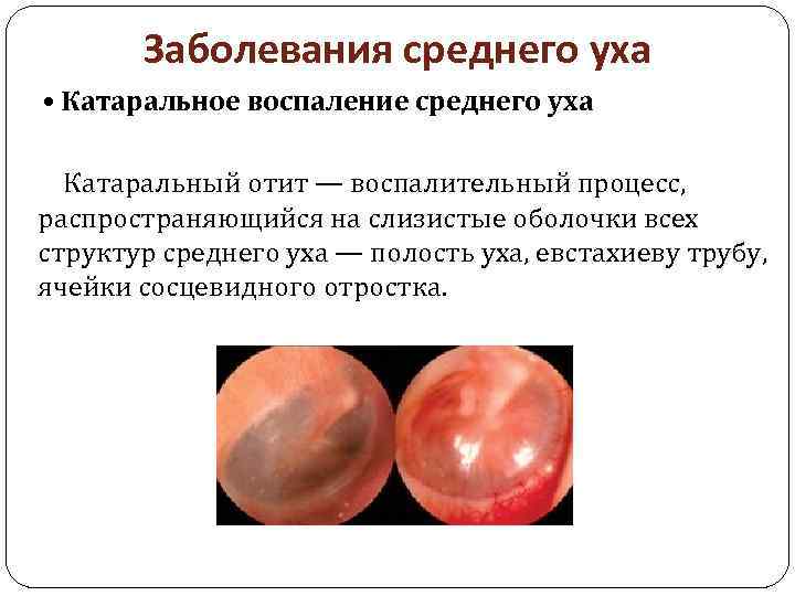 Заболевания среднего уха • Катаральное воспаление среднего уха Катаральный отит — воспалительный процесс, распространяющийся