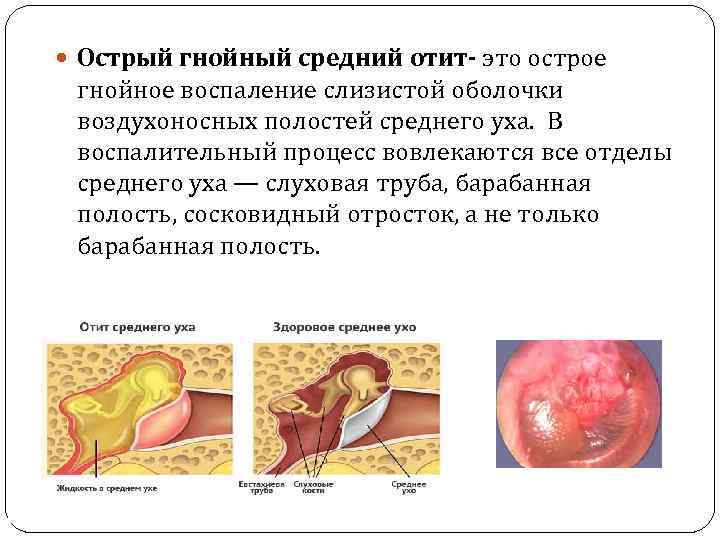  Острый гнойный средний отит- это острое гнойное воспаление слизистой оболочки воздухоносных полостей среднего