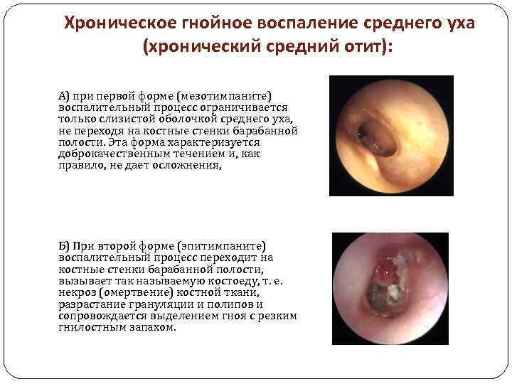  Хроническое гнойное воспаление среднего уха (хронический средний отит): А) при первой форме (мезотимпаните)