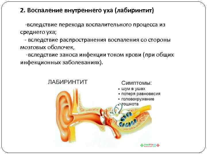2. Воспаление внутреннего уха (лабиринтит) -вследствие перехода воспалительного процесса из среднего уха; - вследствие