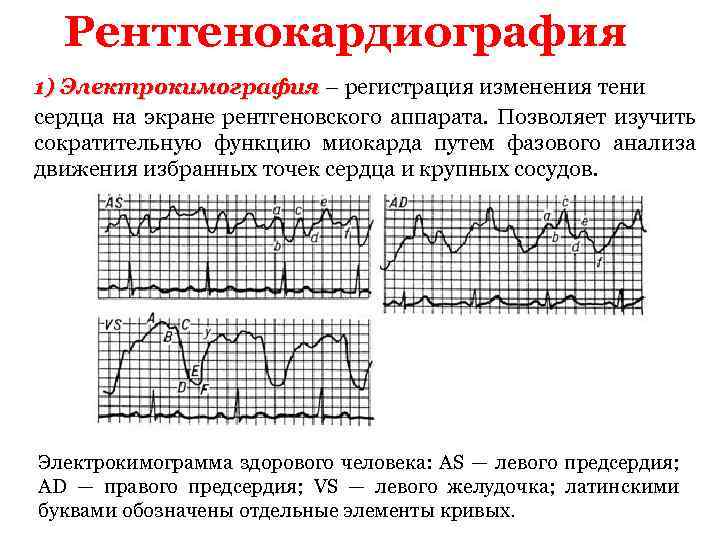 Рентгенокардиография 1) Электрокимография – регистрация изменения тени сердца на экране рентгеновского аппарата. Позволяет изучить