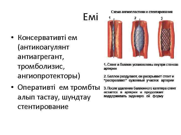 Емі • Консервативті ем (антикоагулянт антиагрегант, тромболизис, ангиопротекторы) • Оперативті ем тромбты алып тастау,